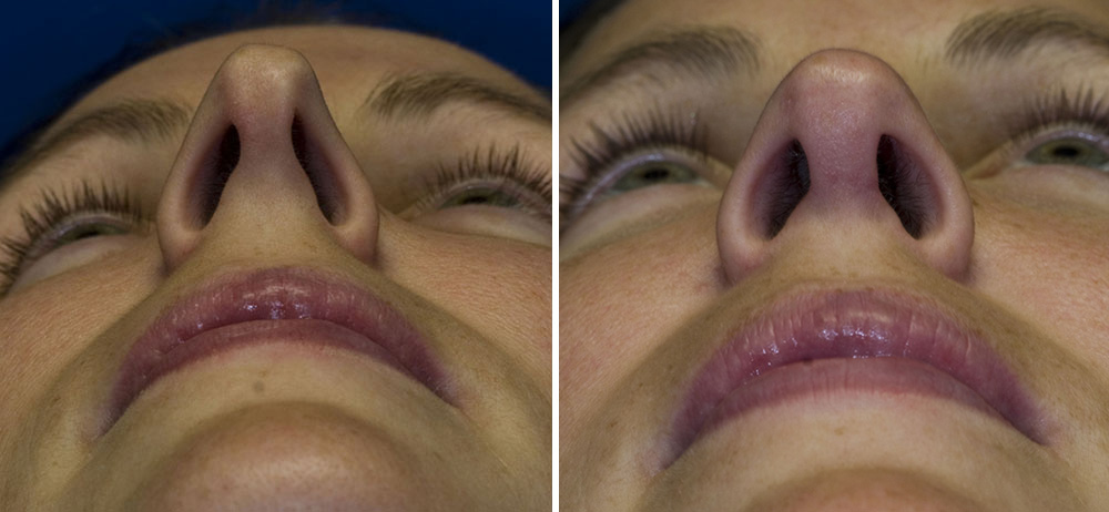 Asymmetric nostril length and size repair Asymmetric nostril length and size repair