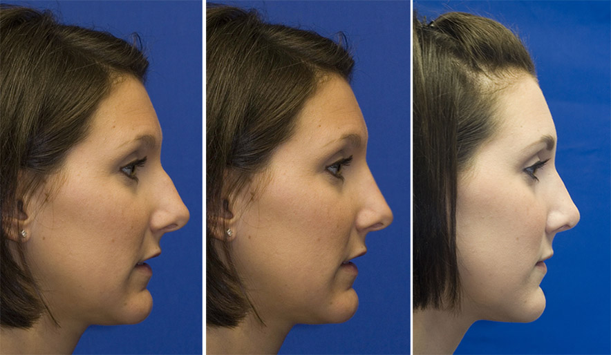 Plastic surgery computer morph profile. Computer simulation is the center pane.