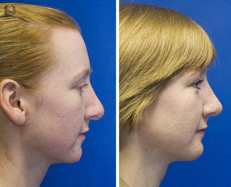 Combined revision rhinoplasty and chin implantation