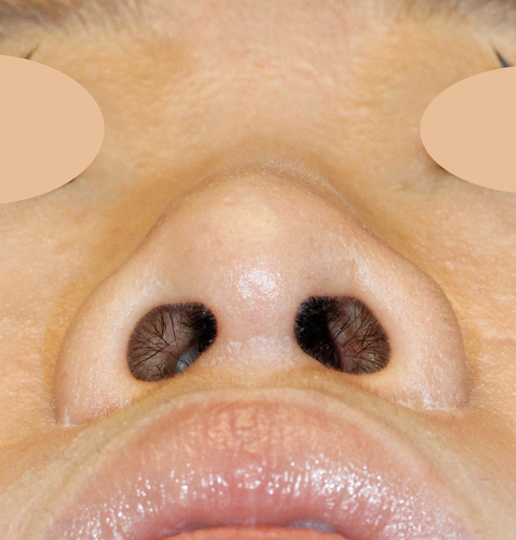 Postop Asian rhinoplasty detail witih nostril reduction