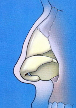profile-nasal-anatomy-showing-hump-in-both-bony-and-cartilage-components.jpg