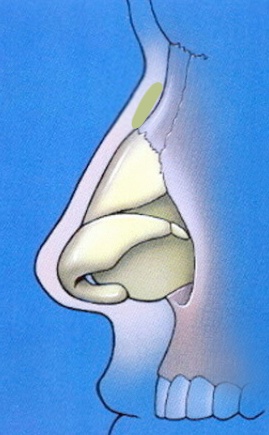 Pseudohump with radix graft in place