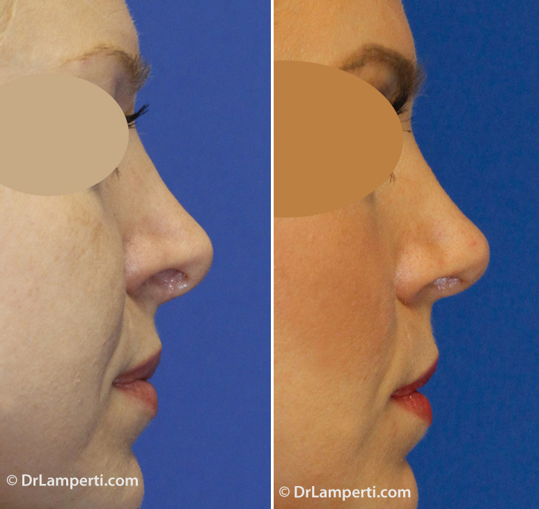 Revision rhinoplasty to correct excess columellar show and hanging columella before and after photo Revision rhinoplasty to correct excess columellar show and hanging columella before and after photo