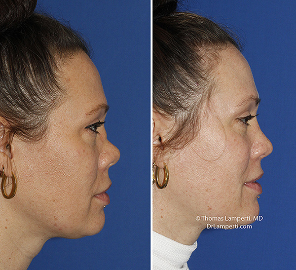 Rhinoplasty patient 71 saddle nose repair right profile before and after.jpg