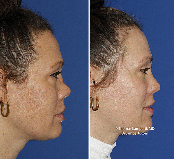 Saddle Nose Deformity Rhinoplasty In Seattle Rhinoplasty Surgeon