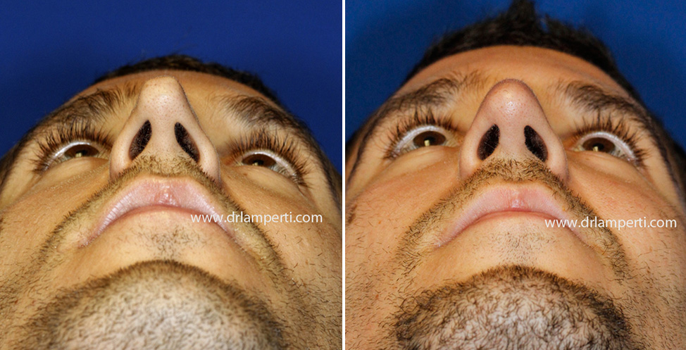 Revision rhinoplasty patient 11 asymmetric nostril repair base view Revision rhinoplasty patient 11 asymmetric nostril repair base view