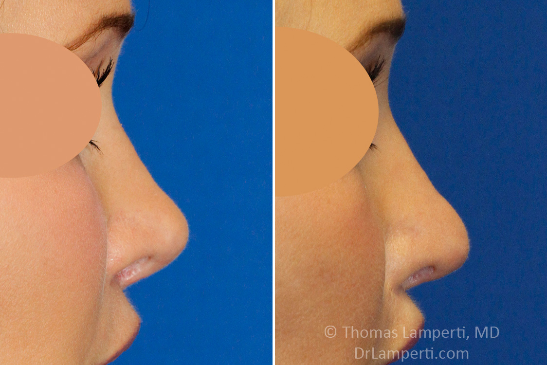 Revision rhinoplasty patient 17 right profile