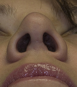 revision-rhinoplasty-patient-2-columellar-incision.jpg