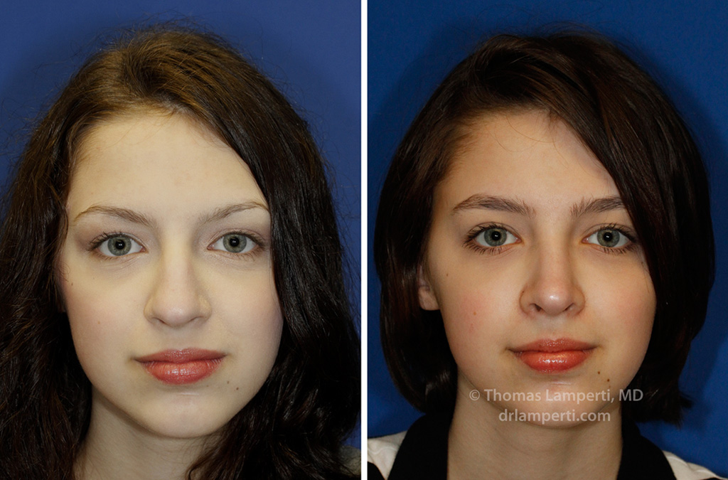 rhinoplasty-45-frontal-montage.jpg