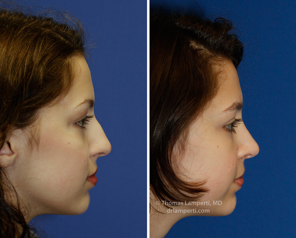 Rhinoplasty patient 45 Right Profile Before and After hump removal