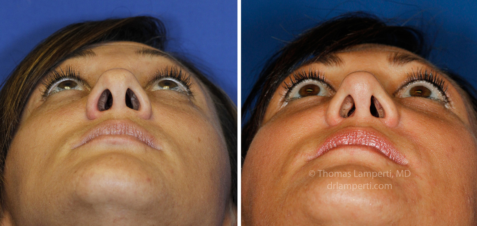 rhinoplasty-48-base-montage.jpg