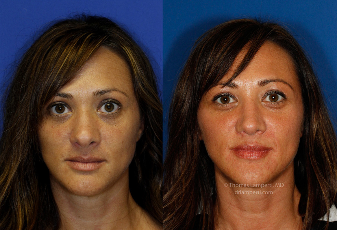 rhinoplasty-48-frontal-montage.jpg