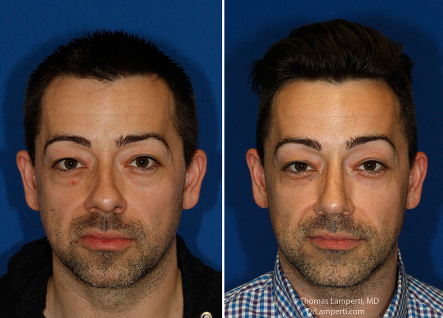 Rhinoplasty patient 52 frontal bulbous nose repair