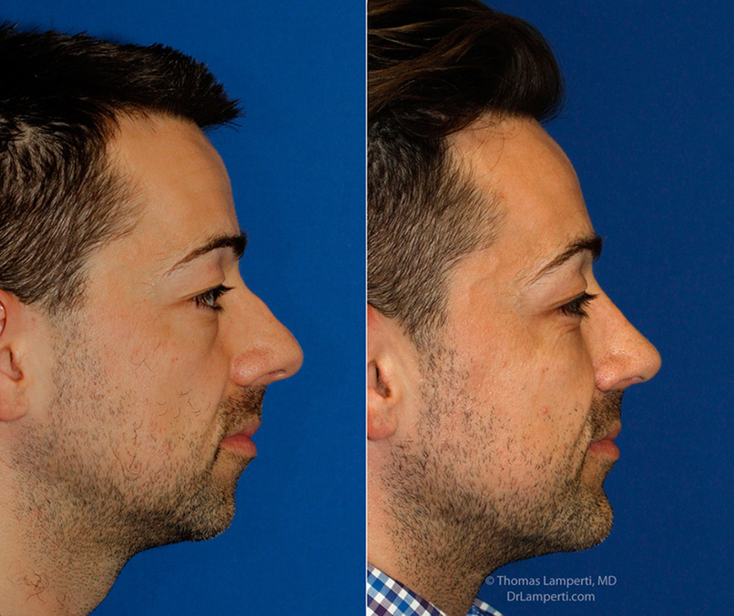 Rhinoplasty patient 52 R profile hump removal