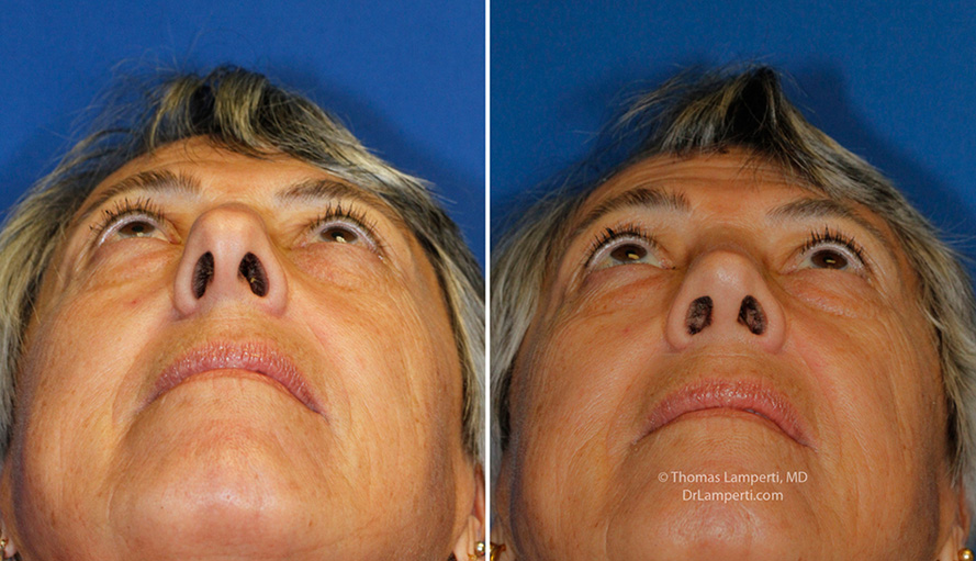 Rhinoplasty patient 56 base