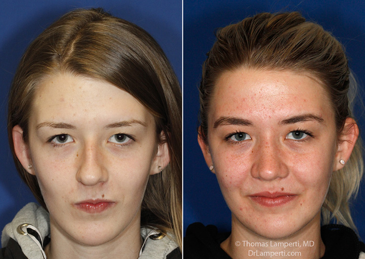 Rhinoplasty patient 64 crooked nose repair before and after