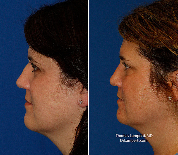 Rhinoplasty patient 65 left profile before and after hump removal montage photo