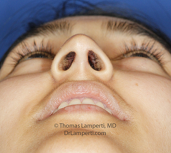 Rhinoplasty patient 66 base after columellar incision