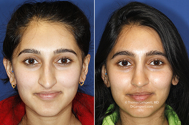 Rhinoplasty patient 66 frontal crooked nose repair before and after