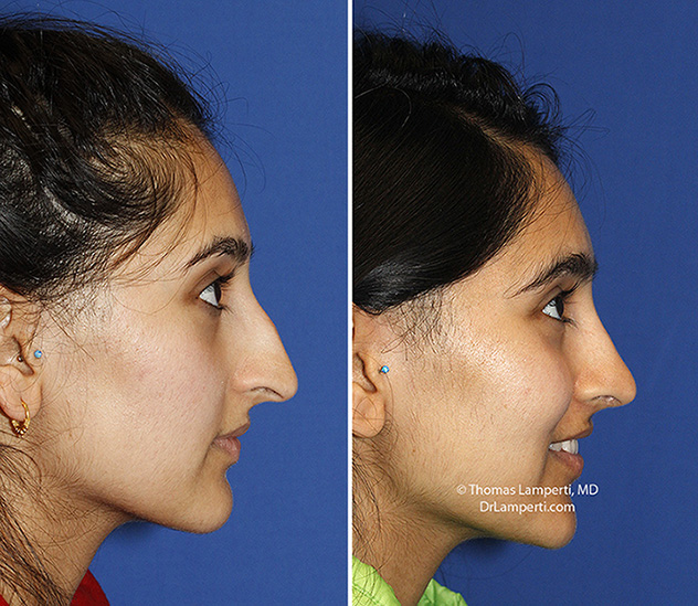 Rhinoplasty patient 66 before and after droopy tip repair R profile