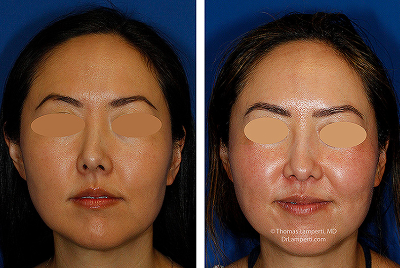 Rhinoplasty patient 69 before and after crooked nose montage