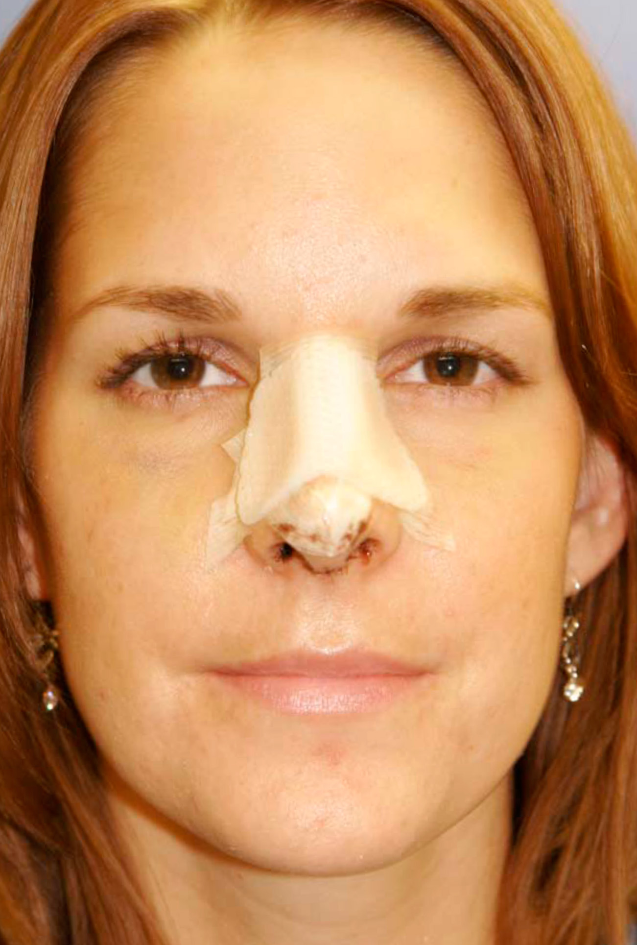 Rhinoplasty Cast