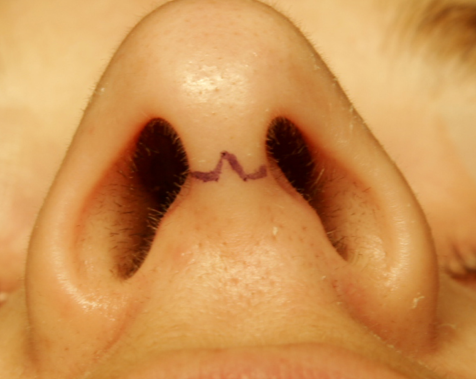External or open rhinoplasty trans-columellar incision marking right before surgery