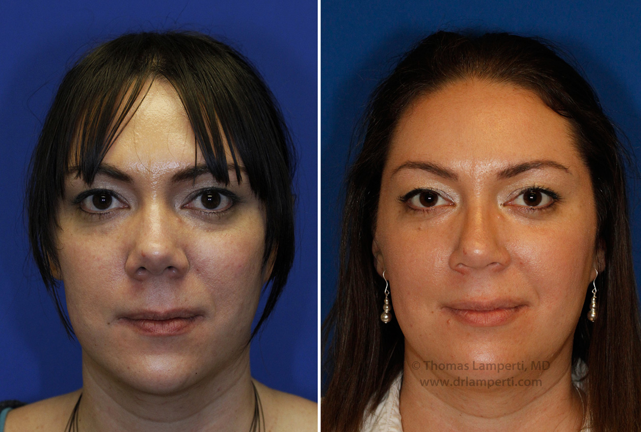 rhinoplasty patient 46 nostril and bridge narrowing in patient with upturned tip