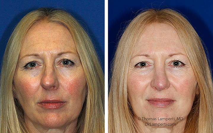 Rhinoplasty patient 72 crooked nose repair frontal before and after montage.jpg
