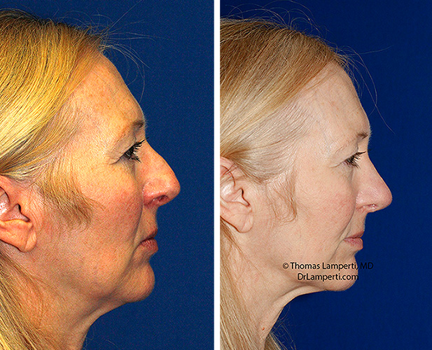 Rhinoplasty patient 72 before and after bridge hump smoothing right profile.jpg