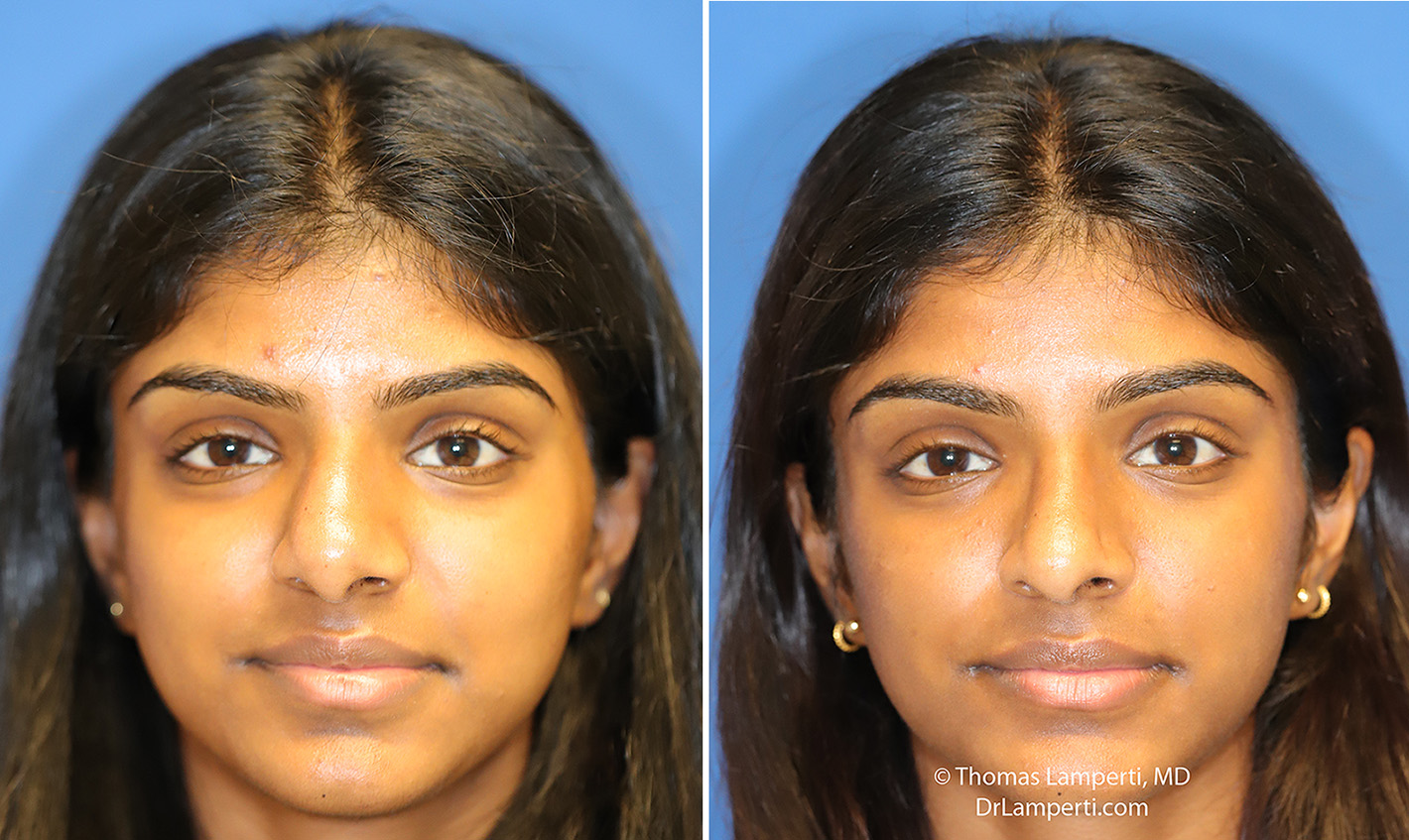 Rhinoplasty patient 74 before and after crooked nose treatment