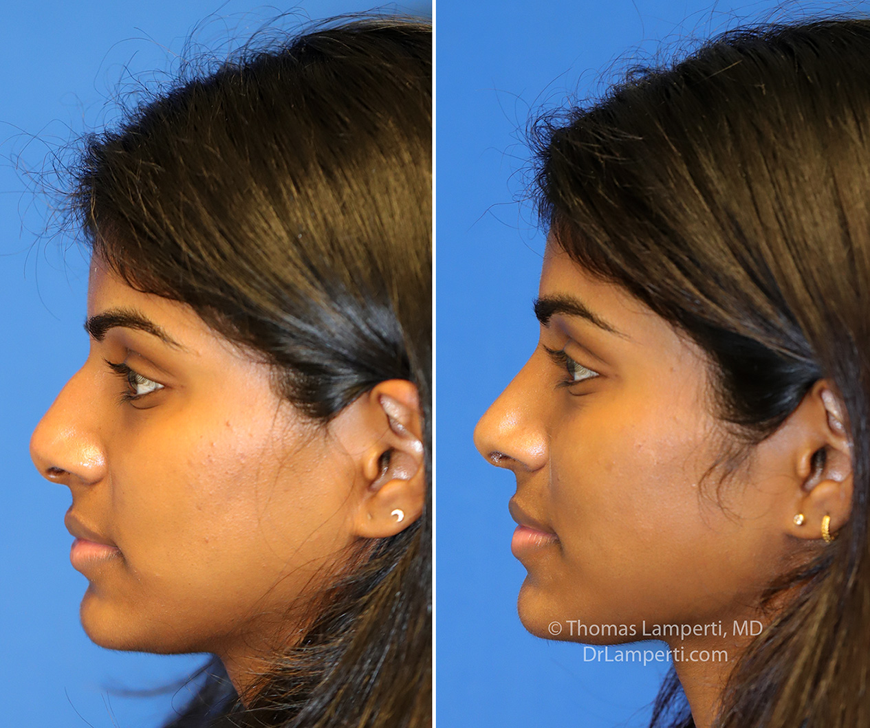 Rhinoplasty patient 74 left profile before and after photos