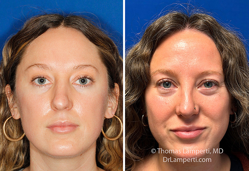 Rhinoplasty patient 75 frontal view montage