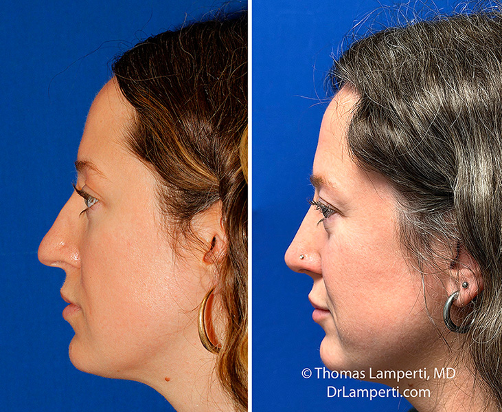 Rhinoplasty patient 75 left profile before and after montage