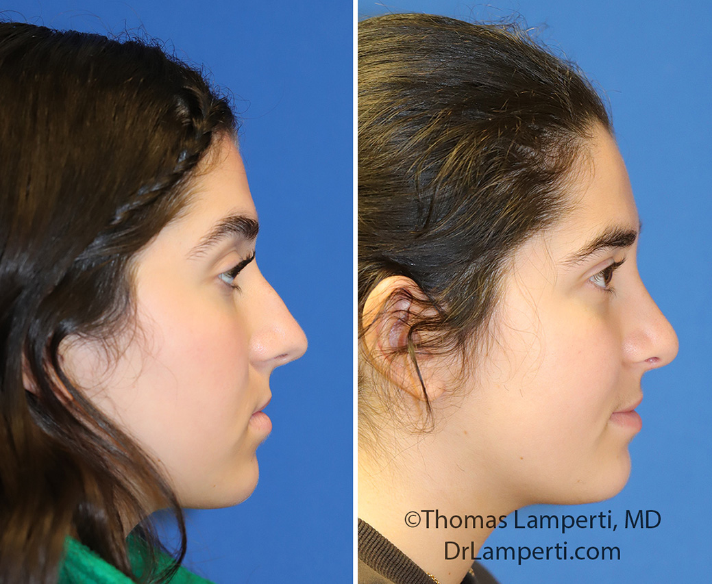 Rhinoplasty patient 76 before and after bridge hump removal