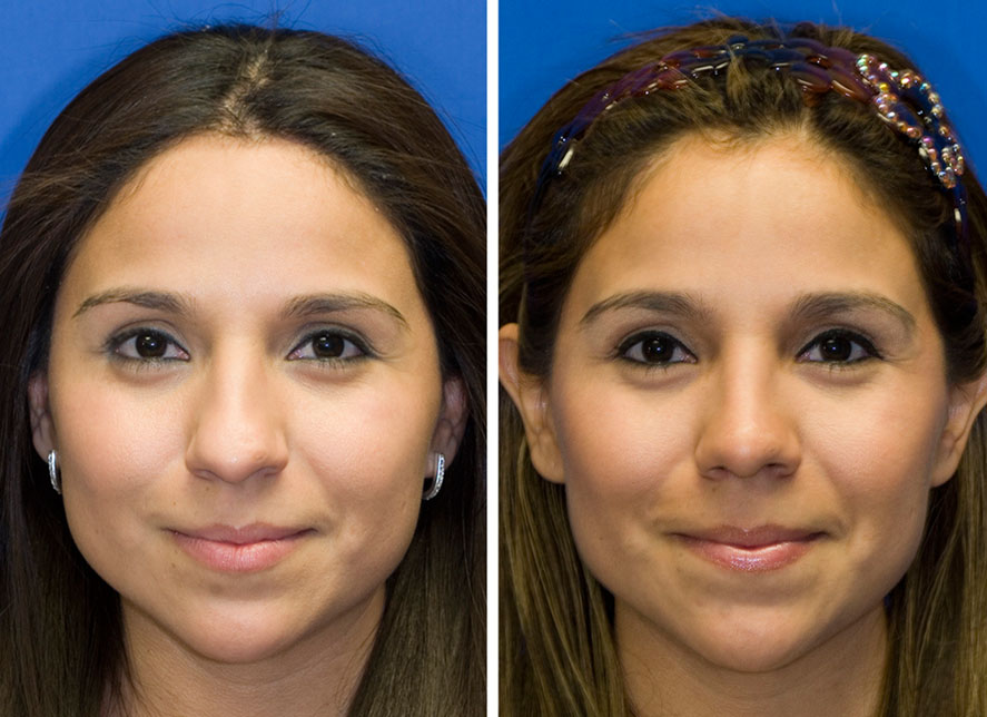 Hispanic woman with bulbous tip rhinoplasty before and after photos