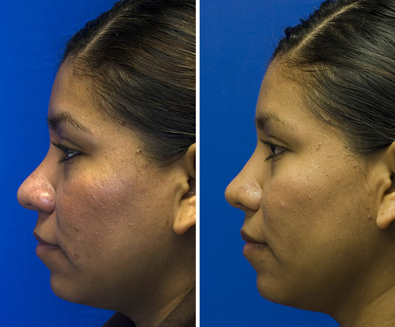 Hispanic rhinoplasty bulbous tip repair with defatting and radix grafting