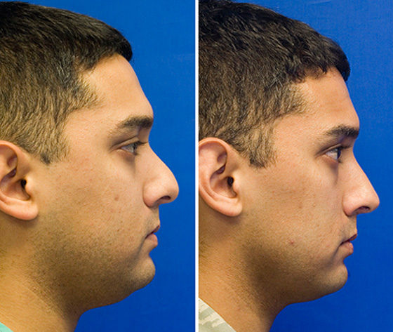 Patient 22 before and after hump reduction and tip ptosis repair