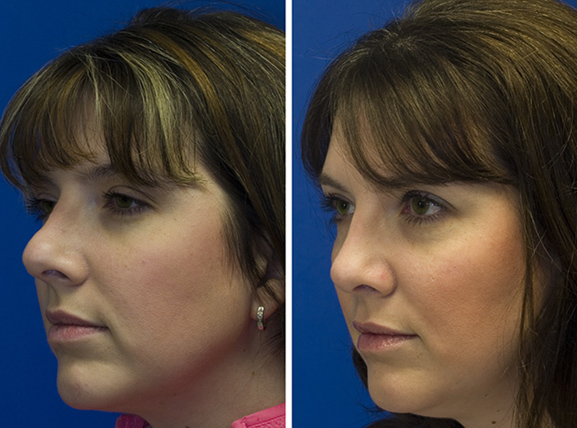Revision rhinoplasty patient 2 oblique view